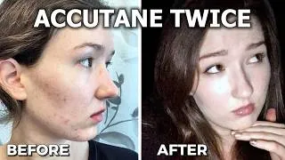 Thumbnail: How I Got Rid of Adult Acne 💊 Accutane Before & After