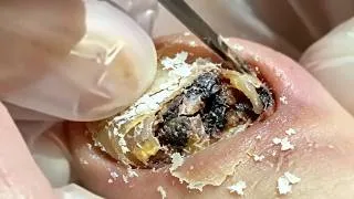 Thumbnail: The process of repairing paronychia!