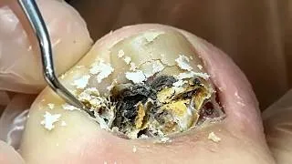 Thumbnail: The most difficult toenail to dig!