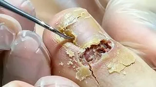 Thumbnail: Record the process of correcting paronychia three times!