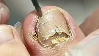 Thumbnail: The boy's love for basketball led to his toenail digging into the flesh!