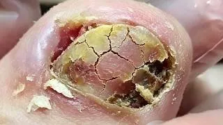 Thumbnail: The stubborn ingrown toenail was finally completely removed!