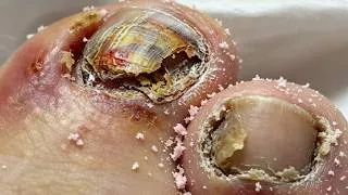Thumbnail: Handling plantar warts for years has been so stress-relieving!