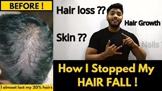 Thumbnail: How I Stopped My Hairfall ? | 3 Products that help me |*Dermatologist tested*| Yash Aesthetic