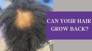 Thumbnail: Can Your Hair Grow Back? Discover the Answers Here!