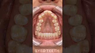 Thumbnail: V-Shaped Dental Arch Expanded 😱 Amazing Braces Smile Widening #Shorts