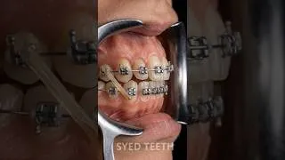 Thumbnail: Extreme Overbite Fixed with Braces 😱 Perfect Bite Transformation #Shorts