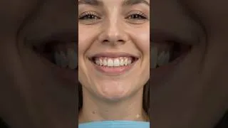 Thumbnail: Severely Crooked Teeth Fixed with Braces 😱 Incredible Smile Transformation #Shorts