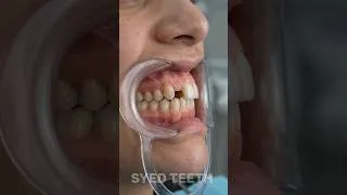 Thumbnail: Extreme Underbite Fixed with Braces 😱 Amazing Jaw Transformation #Shorts