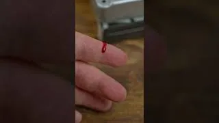Thumbnail: Xbox Upgrade Causes BRUTAL Injury (Not Clickbait) (Gone Wrong)