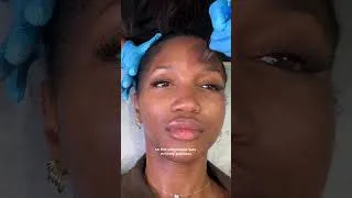 Thumbnail: Come with me to get microneedling!