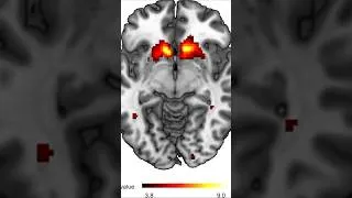 Thumbnail: The Brain Treats Trading Wins Like Cocaine