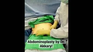 Thumbnail: Tummy Tuck by Dr. Akkary!