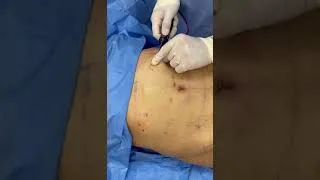 Thumbnail: Renuvion is a minimally invasive procedure that can help improve skin laxity!