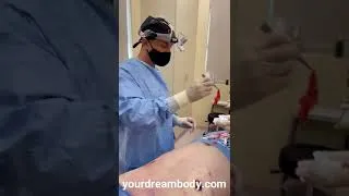 Thumbnail: Gynecomastia excision