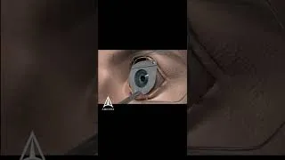 Thumbnail: Learn about LASIK eye surgery l #shorts #3d #animation