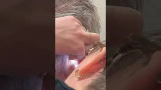Thumbnail: Earwax removal two ways! #audiology #earwaxcleaning #earwaxremoval #satisfying #asmr