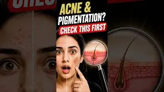 Thumbnail: The Real Cause of Acne & Pigmentation | Ayurveda Explains #skincare #ayurveda #skincareroutine #acne