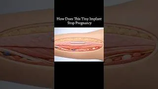 Thumbnail: How does this tiny implant stop pregnancy #viral #animation #pregnancy