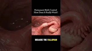Thumbnail: Permanent birth control #pregnancy #viral #modernfertility