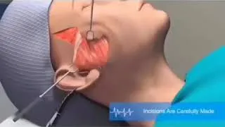 Thumbnail: How A Facelift Works