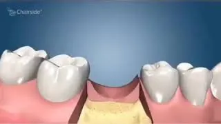 Thumbnail: Dental Implants