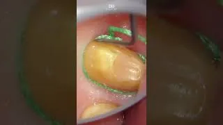 Thumbnail: Retraction in detail. #prep #retraction #dentistry