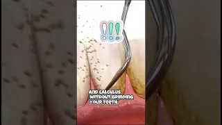 Thumbnail: Scaling teeth ruin your tooth enamel??Watch full video on our channel!!#scaling#teeth #cleaning
