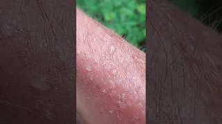 Thumbnail: 🔥 Sunburn Disaster! -- Blistering Skin After Days on the Road