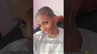 Thumbnail: 13Days post hair transplant journey ❤️ no regrets ✨️😌 #trusttheprocess