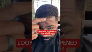 Thumbnail: WTF happened to my hairline!