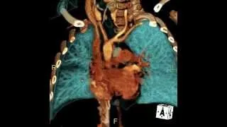 Thumbnail: CV- Cardiac Imaging (CTA/MRI)