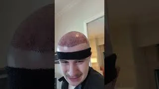 Thumbnail: My Hair Transplant Journey 2 - Vera Clinic