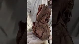 Thumbnail: HEART:Anatomical position