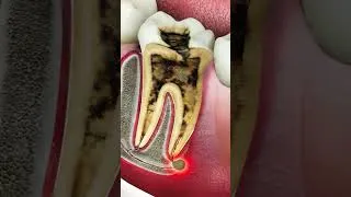 Thumbnail: Endodontic root canal infection process | The reason behind severe pain| Curveia Dental #rootcanal