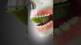 Thumbnail: Bionator Appliances for Orthodontic Treatment | Curveia Dental #dentistry #viralshorts