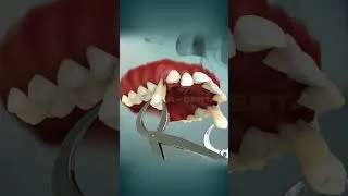 Thumbnail: Braces and Extraction | Curveia | #braces