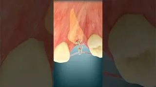 Thumbnail: Impacted canine traction |  Curveia Dental  #shorts
