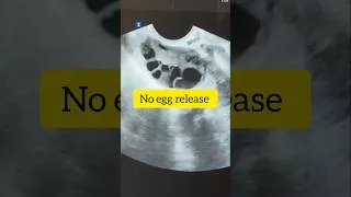 Thumbnail: PCOS ovaries #pcos #pcosinfertility #pcod #viralvideo