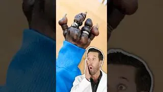Thumbnail: ER Doctor REACTS to Stuck Ring on Finger for Years