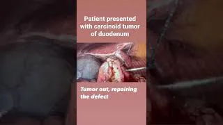Thumbnail: Robotic Duodenal Tumor Removal
