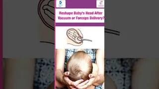 Thumbnail: Will my baby’s head shape fix itself after vacuum or forceps delivery?