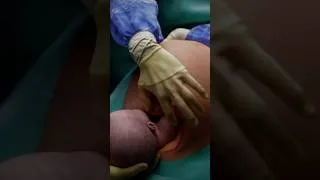 Thumbnail: C-Section | 3D Animation