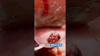 Thumbnail: 3 Signs of Prostate Cancer | 3D Animation