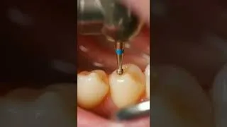 Thumbnail: Root Canal Treatment.                 Save your tooth.