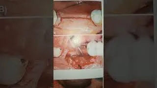 Thumbnail: Implant Placement Surgery
