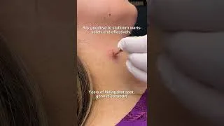 Thumbnail: Warts? Gone in minutes with CO2 laser