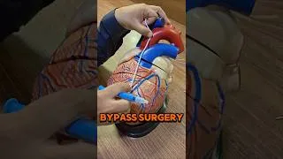 Thumbnail: What is Bypass Surgery #bypass #bypasssurgery #cabg #heartattack #fyp