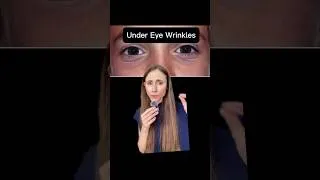 Thumbnail: Wrinkles Under 30? Here's Why #dermatologistadvice