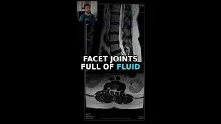 Thumbnail: Facet Joint Synovitis = Spinal Instability 🚨